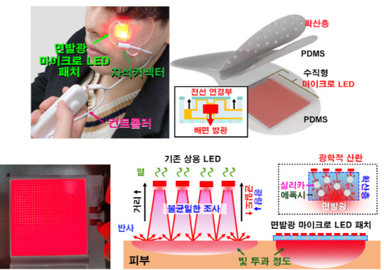 KAIST는 멜라닌 생성을 억제하는 '면 발광 마이크로 LED 피부 패치'를 개발했다. 피부에 밀착해 구동 가능하며 기존 상용 LED 대비 효율적으로 피부에 침투시킬 수 있다.  KAIST 제공